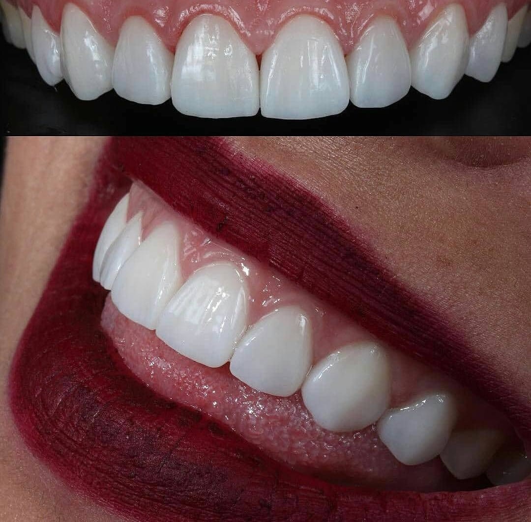 Veneers Image